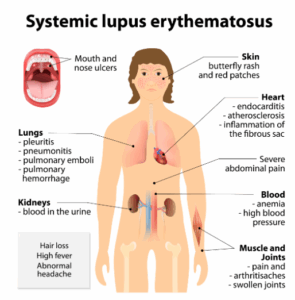 Medical Marijuana And Lupus