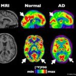 Cannabis and CBD May Help Patients With Alzheimer’s and Dementia